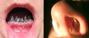 poškodenie ústnej a nosovej dutiny šnupaním kokaínu