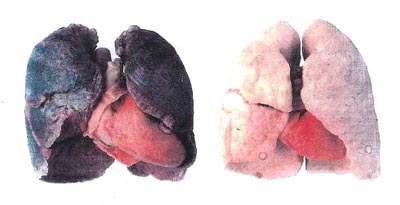 porovnanie pľúc a srdca fajčiara (vľavo) a nefajčiara (vpravo)